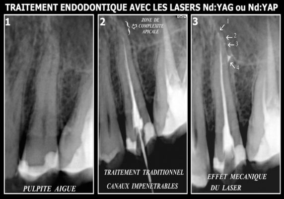 14 572x400 - Endodontie : applications aux soins des canaux dentaires
