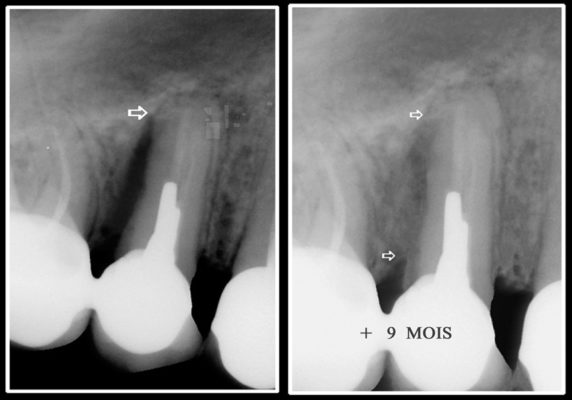 19 572x400 - Parodontie : les traitements laser assistes sur les infections bacteriennes et les dents déchaussées