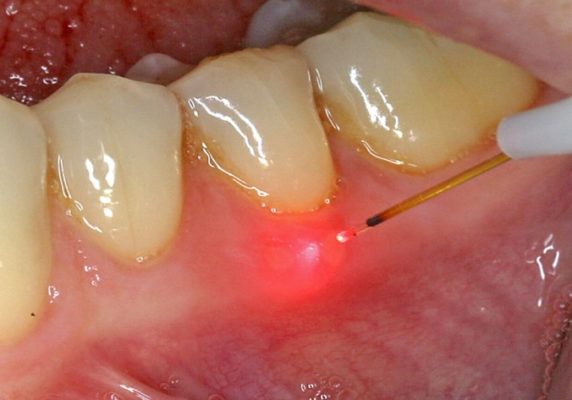 21 572x400 - Bénéfices des traitements laser dans les maladies de la bouche, type aphtes et herpes