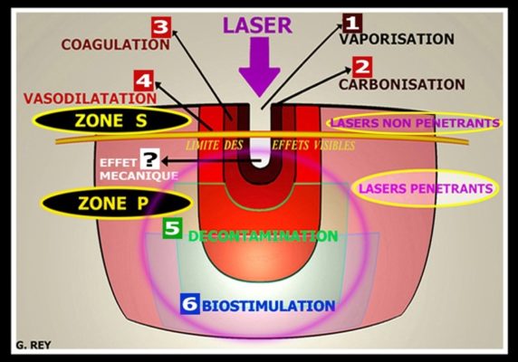 4 2 572x400 - Les principaux effets et comportements des differents rayonnements laser sur les tissus de la cavite buccodentaire