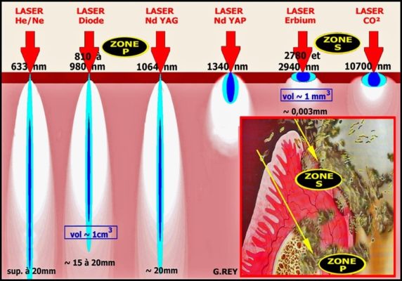 6 2 572x400 - Les principaux effets et comportements des differents rayonnements laser sur les tissus de la cavite buccodentaire